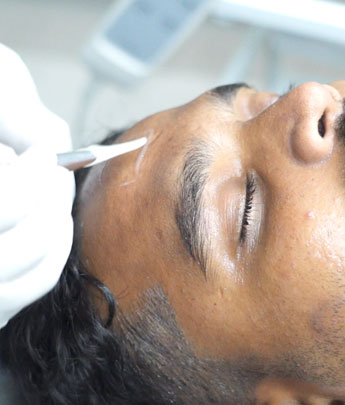 Advanced Chemical Peels