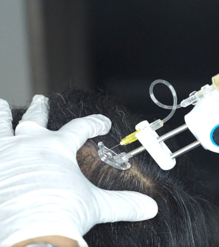 Hair Regrowth Specialists Cuddalore