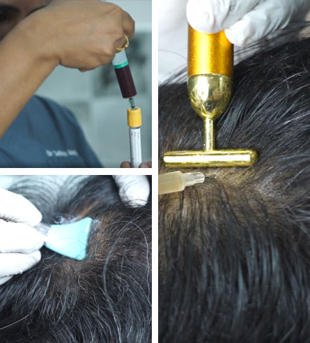 Hair Treatment - Cuddalore