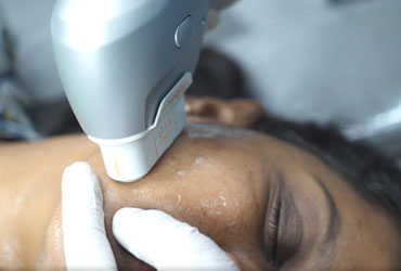 Skin Tightening Treatment in Cuddalore