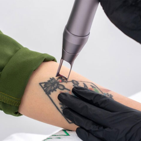 Tattoo Removal in Cuddalore