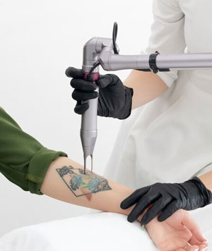 Laser Tattoo Removal in Cuddalore