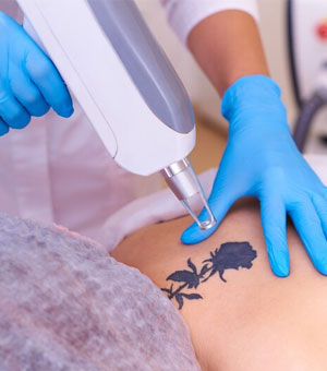 Tattoo Removal in Cuddalore