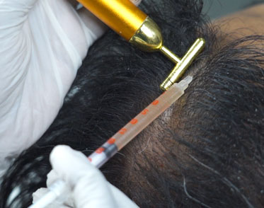 Hair Fall Treatment